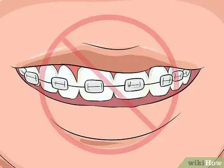 Image titled Choose the Color of Your Braces Step 13