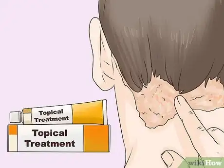 Image titled Get Rid of an Itchy Scalp Step 9