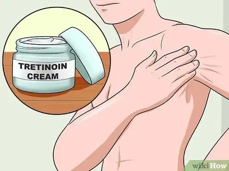 Image titled Get Rid of Stretch Marks Fast Step 10