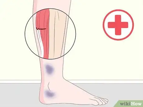 Image titled Get Rid of Leg Pain Step 13