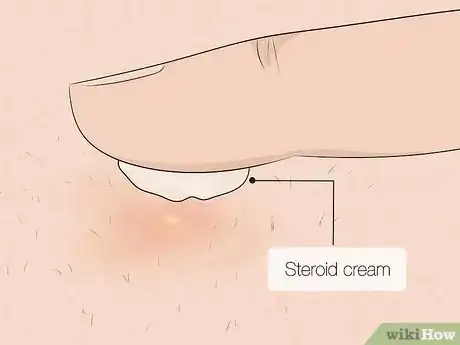 Image titled Remove an Ingrown Hair Step 3