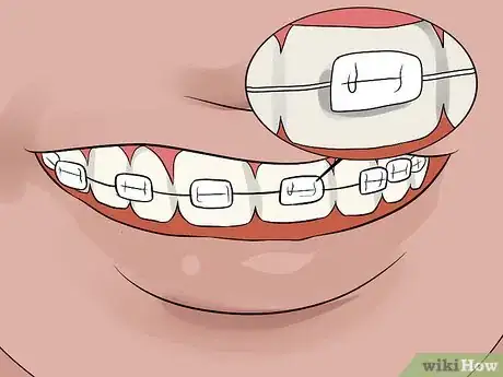 Image titled Whiten Your Teeth when You Have Braces Step 10