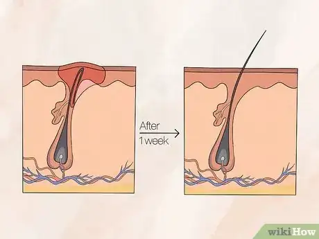 Image titled Remove an Ingrown Hair Step 1