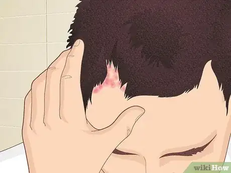 Image titled Bumps on Scalp Step 1