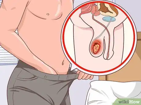 Image titled Treat Testicular Cancer Step 3