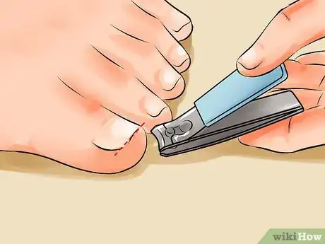 Image titled Remove an Ingrown Toenail Step 19