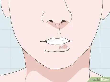 Image titled Cover Up a Cold Sore Step 1