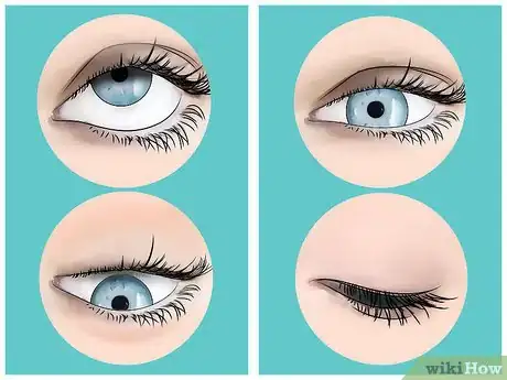 Image titled Get Rid of Eye Floaters Step 5