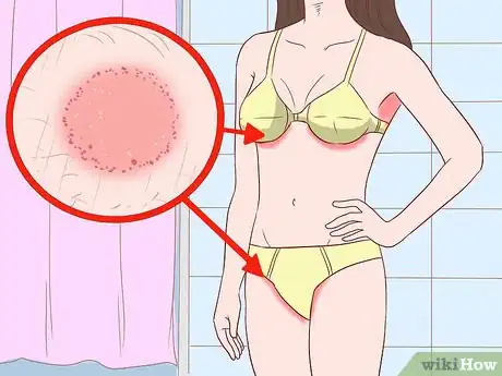 Image titled Prevent Skin Fungus Step 2