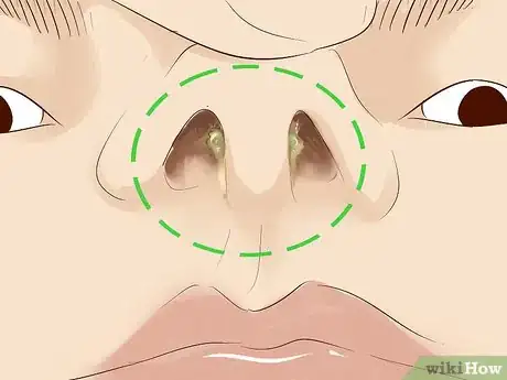 Image titled Get a Septum (Nose Cartilage Wall) Piercing Step 16.jpeg