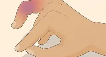 Treat a Jammed Finger