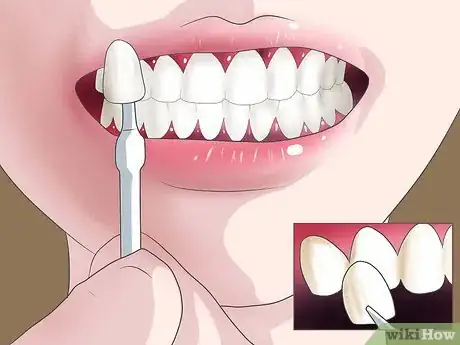 Image titled Bleach Your Teeth Step 7