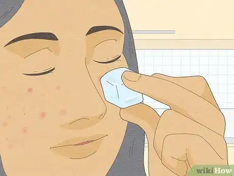 Image titled Get Rid of a Popped Pimple Overnight Step 1