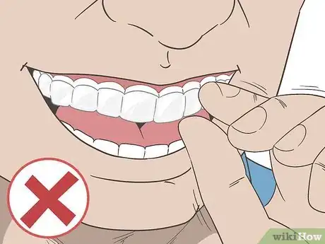 Image titled Put Invisalign Back in if You Haven't Worn Them for a Long Time Step 5