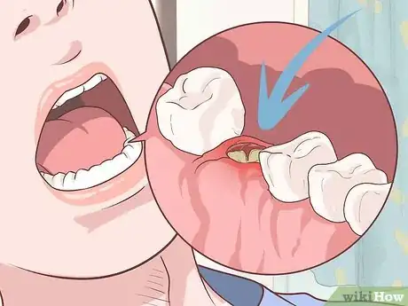 Image titled Prepare for Tooth Extraction Step 13