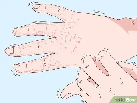 Image titled Treat Hand Eczema Step 1