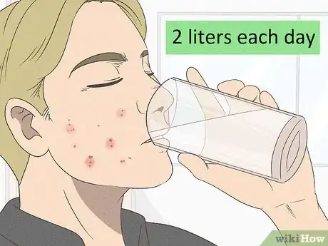 Image titled Clear Bad Skin Step 1