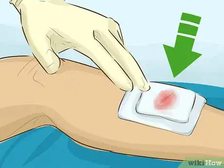 Image titled Stop Bleeding Step 19