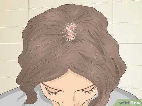 Image titled Bumps on Scalp Step 2