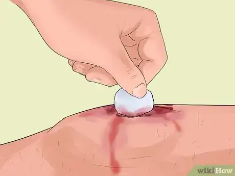 Image titled Treat Severe Bleeding During First Aid Step 4