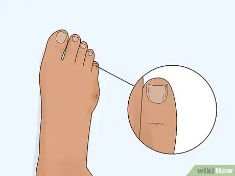 Image titled Heal a Toe Injury Step 3