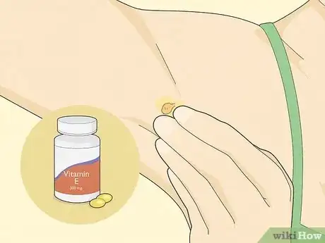 Image titled Get Rid of Skin Tags Step 8
