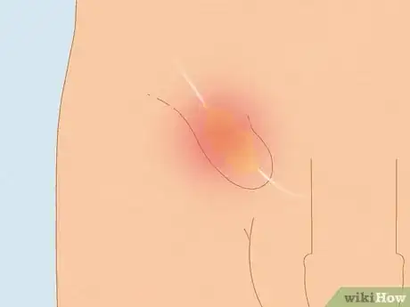 Image titled Recognize Chlamydia Symptoms (for Men) Step 10