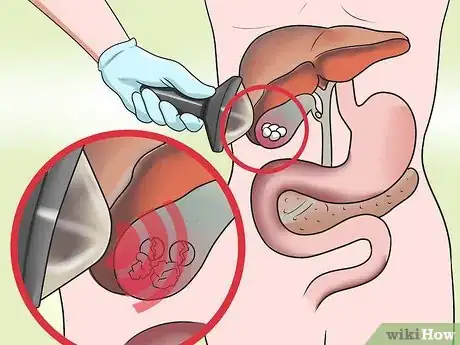 Image titled Dissolve Gallstones Step 3