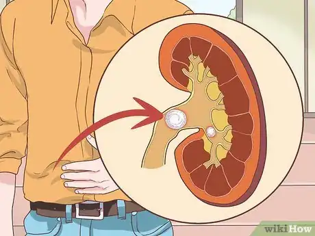 Image titled Know if You Have Kidney Problems Step 1