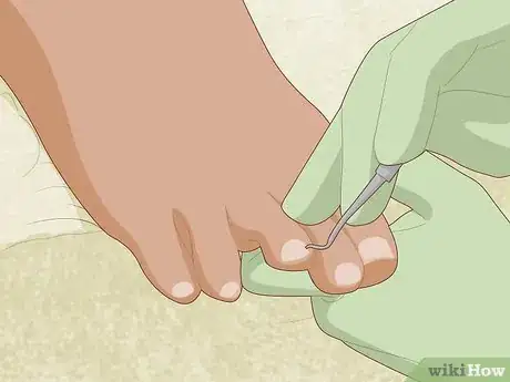 Image titled Prevent Ingrown Nails Step 12