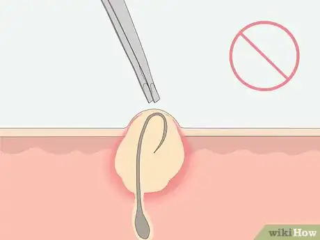 Image titled Get Rid of Ingrown Pubic Hair Step 17