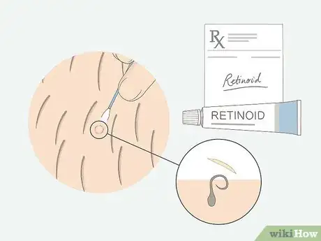 Image titled Get Rid of Ingrown Pubic Hair Step 8