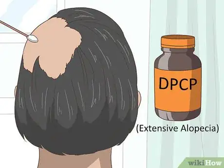 Image titled Treat Alopecia Step 3