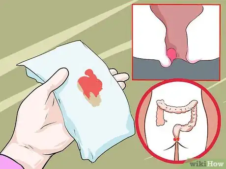 Image titled Treat Hemorrhoids After Pregnancy Step 13