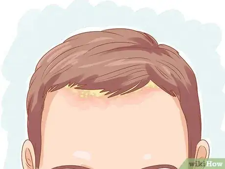 Image titled Get Rid of Dandruff (Natural Methods) Step 12