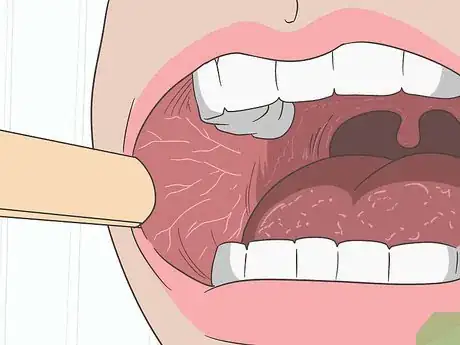 Image titled Treat Mouth Ulcers Naturally Step 16