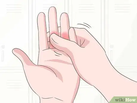 Image titled Reduce Swollen Fingers Step 8