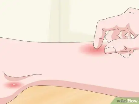 Image titled Detect Flea Bites Step 1