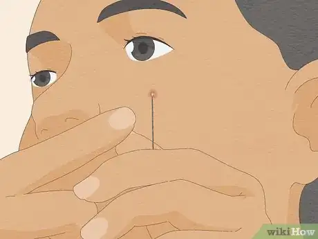 Image titled Pop a Pimple Step 12