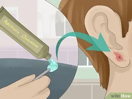 Image titled Clean an Infected Ear Piercing Step 4