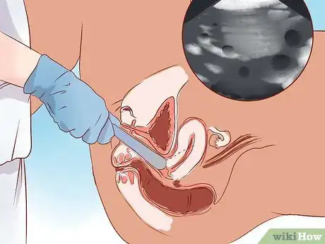 Image titled Detect an Ectopic Pregnancy Step 7