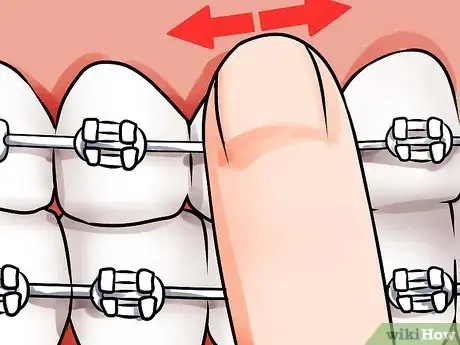 Image titled Apply Dental Wax on Braces Step 8