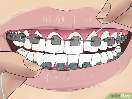 Image titled Floss With Braces Step 6