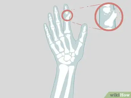 Image titled Determine if a Finger Is Broken Step 17