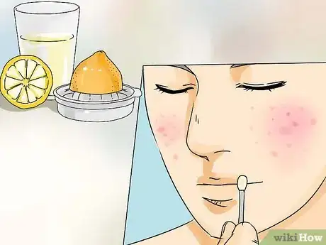 Image titled Get Rid of Pimples on a Tight Budget Step 10