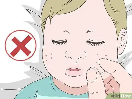 Image titled Get Rid of Baby Acne Step 4