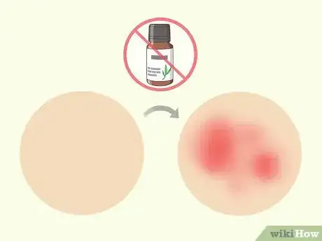 Image titled Treat Cold Sores with Essential Oils Step 9