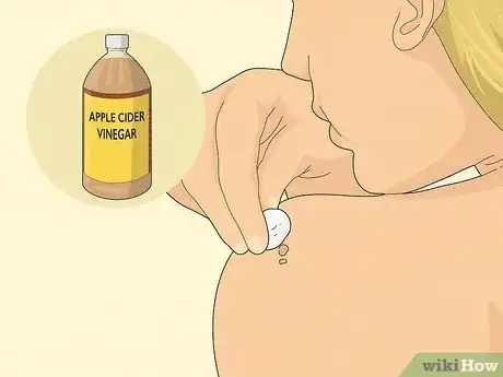 Image titled Get Rid of Skin Tags Step 4