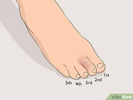 Image titled Buddy Tape an Injured Toe Step 1