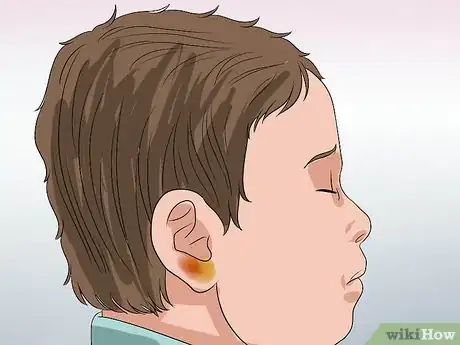 Image titled Know if You Have Otitis Media Step 12